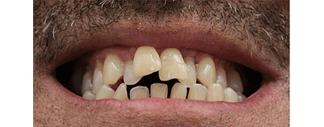 Before Invisalign treatment